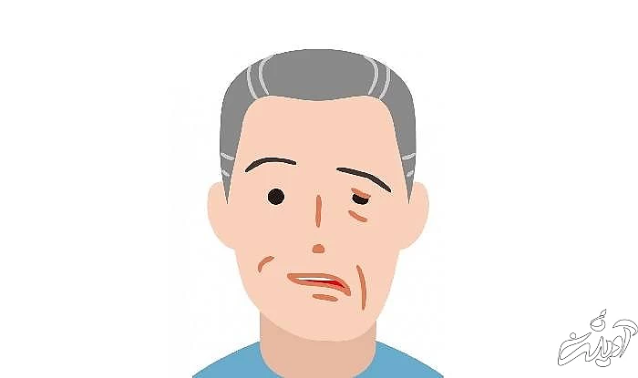 عوارض مختلف بیماری رامسی هانت عوارض رامسی هانت